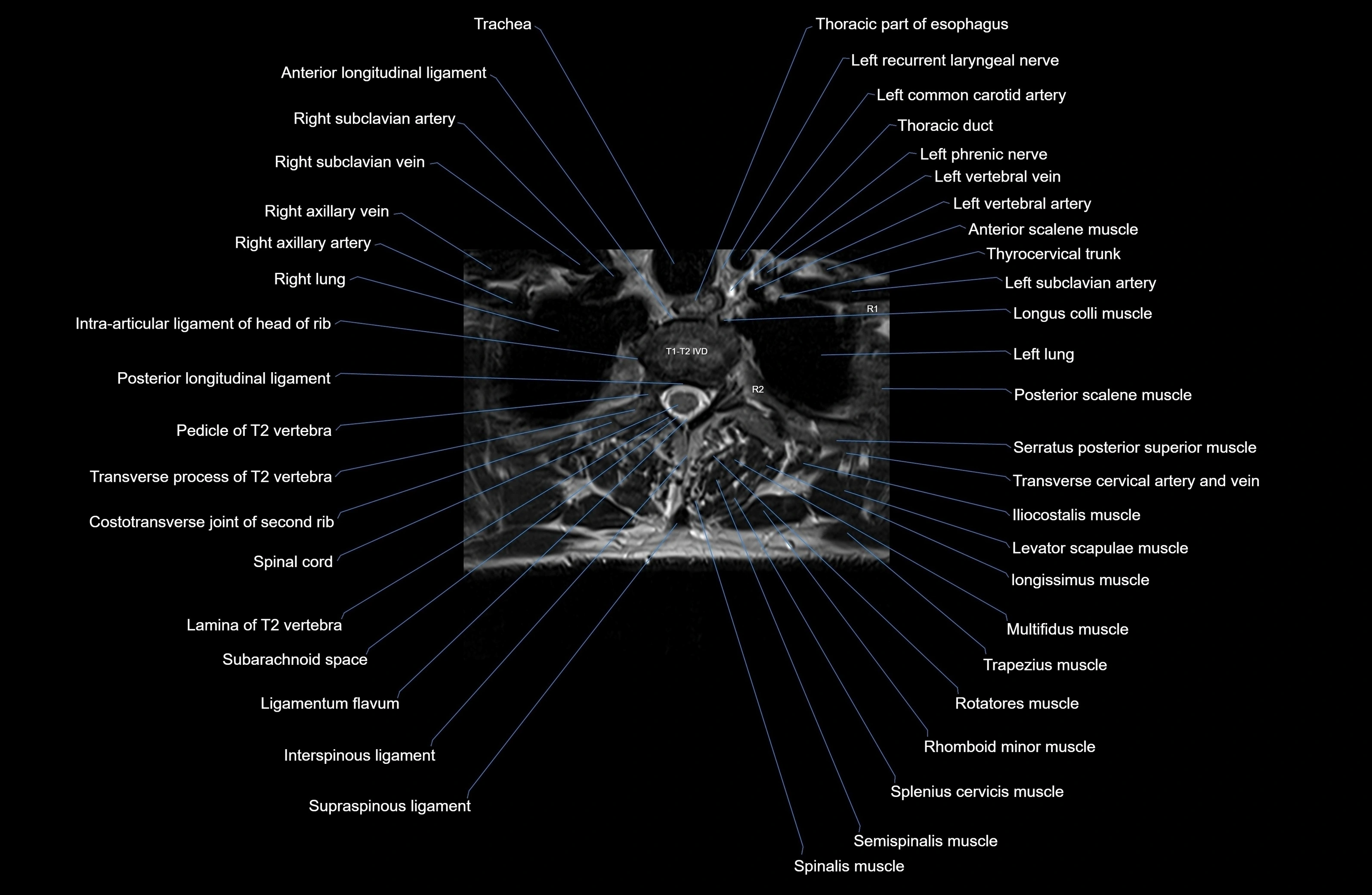 MRI thoracic spine axial  cross sectional anatomy 3T radiology  image-img-00001-00012.webp